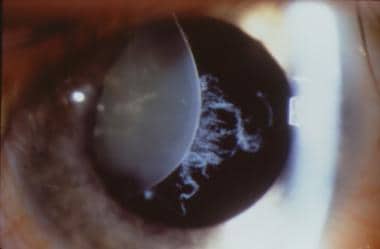 Ectopia lentis. Supertemporal dislocation of a len