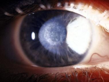 Image of corneal haze following refractive surgery