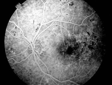 Fluorescein angiogram demonstrating foveal dye lea