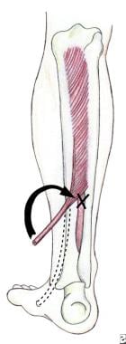 Posterior leg with retrieved posterior tibial tend