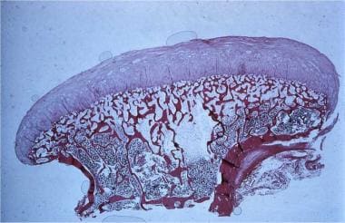 Solitary osteochondroma. Histology of cut osteocho