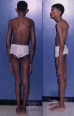 Adult with Marfan syndrome. Note tall and thin bui