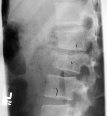 Pre-operative plain radiograph of Dorso-lumbar spine in (1A