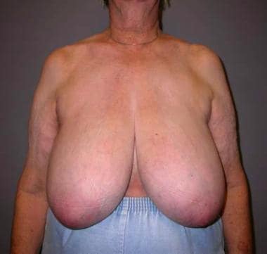Preoperative photograph of the breasts of patient 