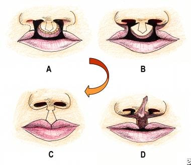 Bilateral cleft lip repair. (A) The prolabial widt