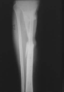 Clinical Case 3. Anteroposterior radiograph of the