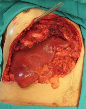 Resultant complex abdominal wall defect following 