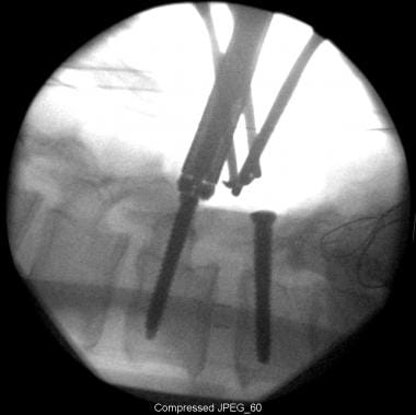 Intraoperative fluoroscopy for pedicle screw inser