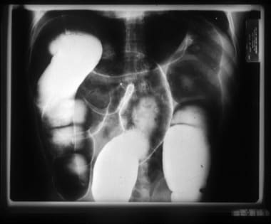 Air-contrast barium enema of a Bolivian patient wi