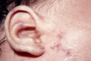 Neisseria meningitis purpuric lesions on the ear a