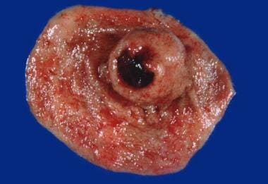 Shown here is a gastric gastrointestinal stromal t