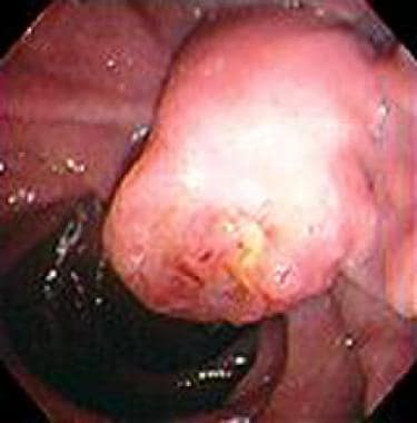 Endoscopic view of an ampullary carcinoma. 