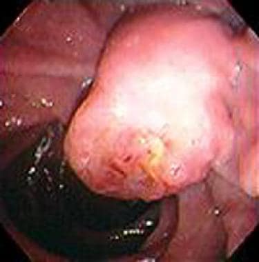 蜂鸣脉癌的内窥镜视图。