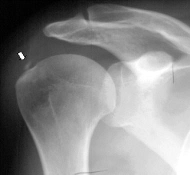 Calcification at the insertion of the rotator cuff