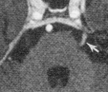 MRI with high resolution on the pons demonstrating