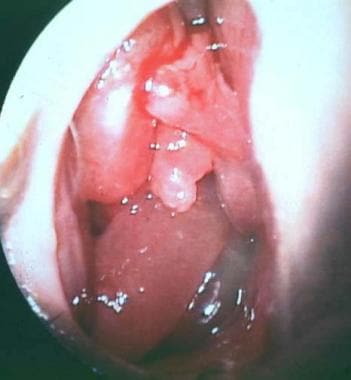 View just inside the nasal vestibule showing diffu