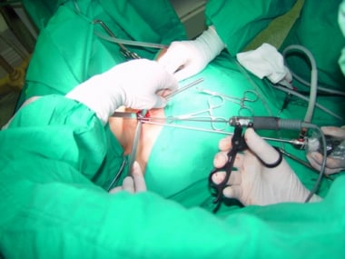 Minimally invasive video-assisted thyroidectomy. C