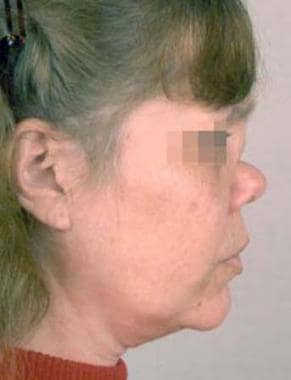 Woman with a subtype of midline granulomatous dise