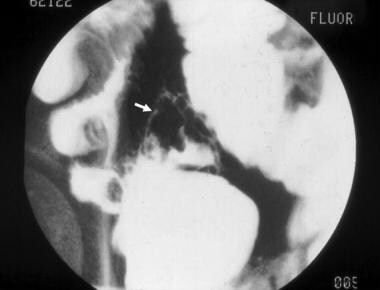 CT scan in a patient with terminal ileal Crohn dis