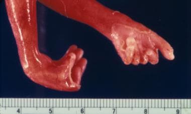 This photo shows the hands of a fetus with trisomy
