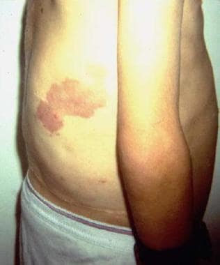 proteus syndrome photos