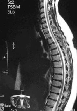 Bulging Disc vs. Herniated Disc: What's the Difference? - Hamid