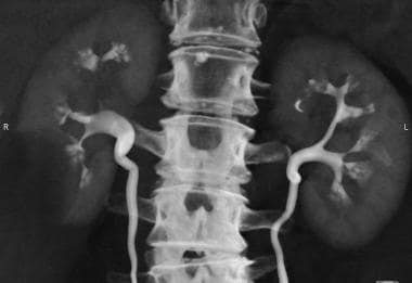 CT image of both kidneys demonstrates brushlike de