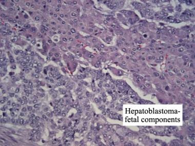 Fetal components of hepatoblastoma. Hematoxylin an