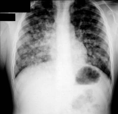 Chest radiograph in a child with infiltrates shows