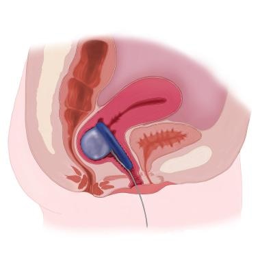 Porn Forced Anal Prolapse Eating - Fecal Incontinence Treatment & Management: Medical Therapy, Surgical  Therapy, Preoperative Details