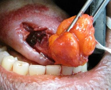 Surgical excision of tongue lesion.