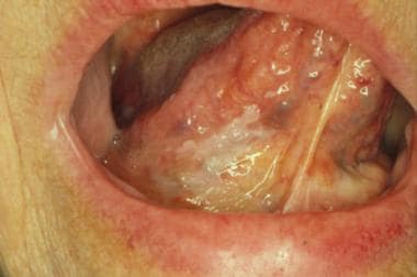 Ventral tongue in oral leukoplakia.