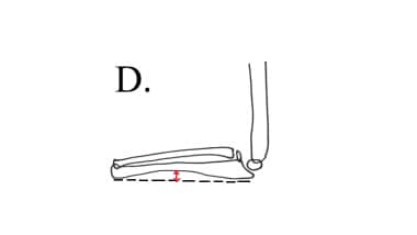Abnormal maximum ulnar bow is present when maximum