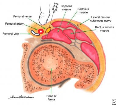 Femoral nerve block technique (cross-sectional vie