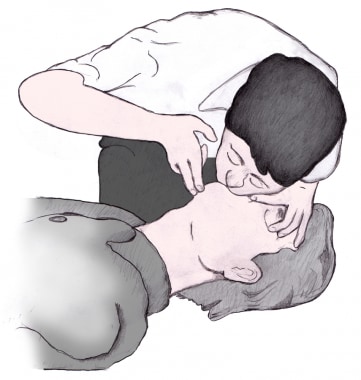 Delivery of mouth-to-mouth ventilations. 

Avoid