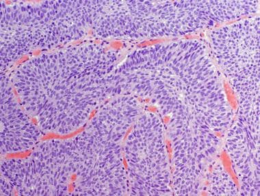 inverted papilloma bladder immunohistochemistry giardia uman tratament