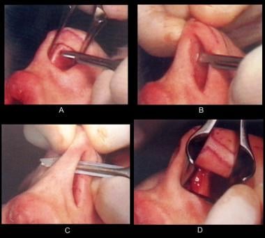 Nasal tip elevation. (A) The transfixion excision 