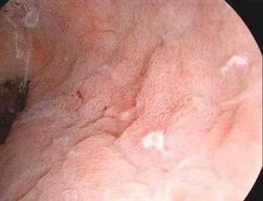 Endoscopic view of superficial gastric neoplasm. 