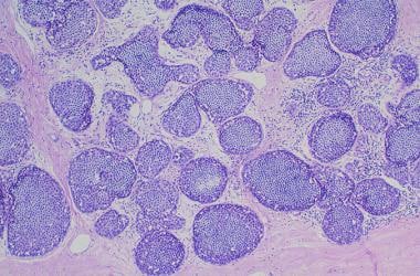 Histopathological image of mixed mucinous breast cancer (MMBC) with