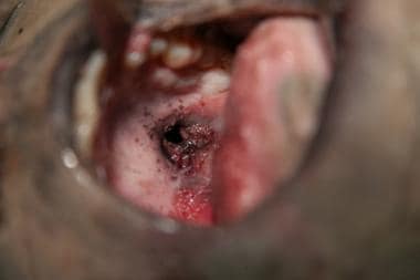 Suicidal gunshot wound on the palate of the oropha