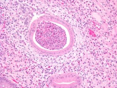 A crypt abscess demonstrating active, neutrophilic