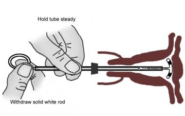 Holding the insertion tube steady and withdrawing 