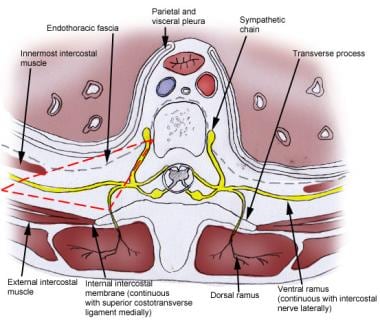 paravertebral block