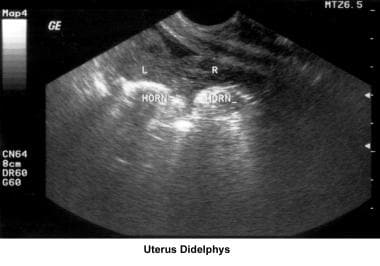 Infertility. Uterus didelphys. Image courtesy of J
