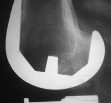 Radiograph of an uncemented, hydroxyapatite-coated