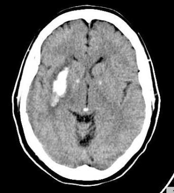A 59-year-old female with hypertension who present