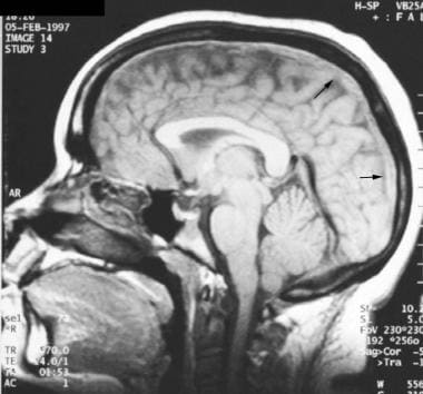 Sagittal T1-weighted image demonstrates T1-hyperin