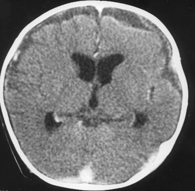 Subdural empyema with strand in a patient with bac