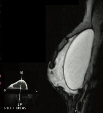 Breast Implant Rupture Imaging: Practice Essentials, Radiography, Magnetic  Resonance Imaging