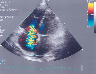 Two-dimensional transthoracic echocardiogram apica